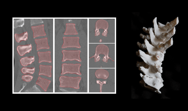 Unsupervised and Semi-Supervised Learning for Bone Segmentation